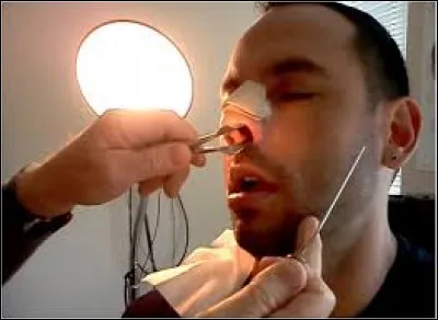 La septoplastie est une opération chirurgicale qui consiste à corriger une déviation de la cloison nasale.