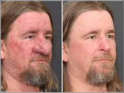 Par quoi le Rhinophyma est-elle povoquée ?