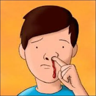 Une &eacute;pistaxis est un saignement par le nez.