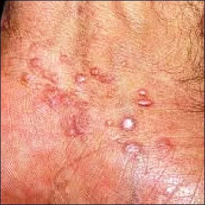 Quel organisme végétal symbiotique partage son nom avec une maladie de la peau ?