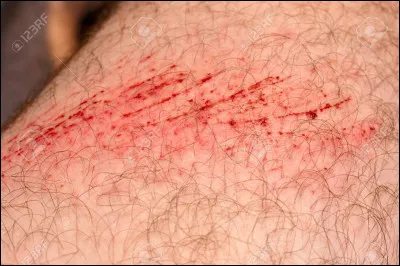 Tu te fais une égratignure au pied, tu :