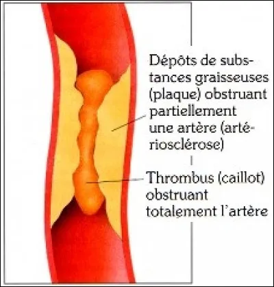 Un infarctus est la fermeture d'un vaisseau par un caillot, une plaque d'athérome... Existe-t-il d'autres infarctus que celui du myocarde ?