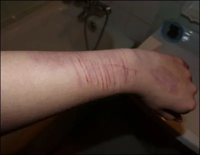 Vous êtes-vous déjà mutilé ?