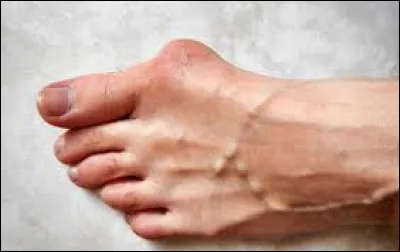 Comment s'appelle cette déformation de l'avant-pied ?