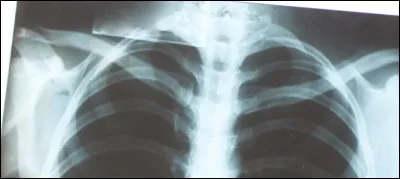 Le BCG est un vaccin contre :