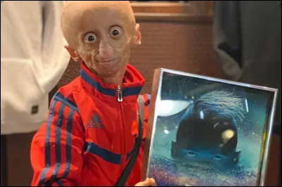 Hommage à Rania, star des réseaux sociaux morte le jeudi 15 octobre 2020. Sa maladie, la progéria, cause-t-elle un vieillissement prématuré du corps ?