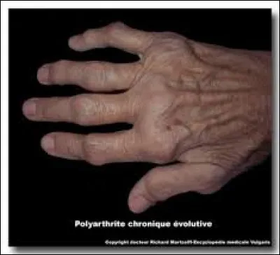 Comment qualifiez-vous la polyarthrite rhumatoïde ?