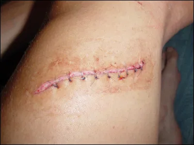 As-tu des cicatrices ?