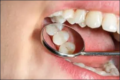 C'est une maladie infectieuse de la dent, est une lésion de l'émail, de la dentine.