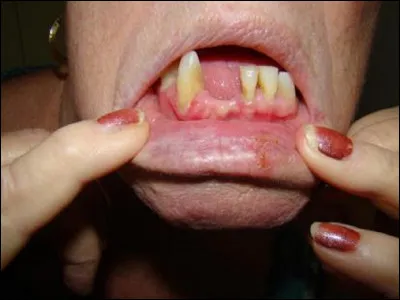 À quoi est dû le scorbut ?