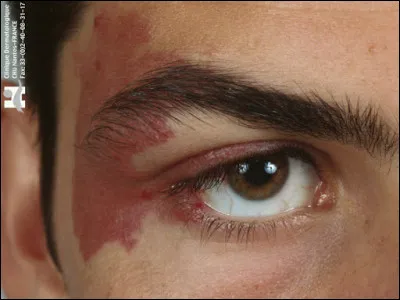 Quel est le terme médical de ''l'envie'' ou tache de vin ?