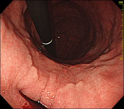 Qu'est6ce que la situs-inversus ?