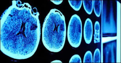 Quels sont les avantages de la médecine nucléaire ?