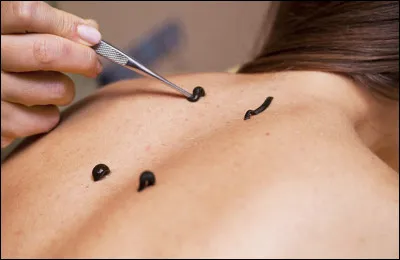Quel est le nom de la pseudo-médecine fondée sur l'utilisation de sangsues (qui sont des vers soit dit en passant) ?