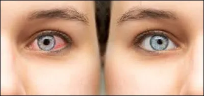 Comment nomme-t-on l'inflammation de cette partie de l'il ?