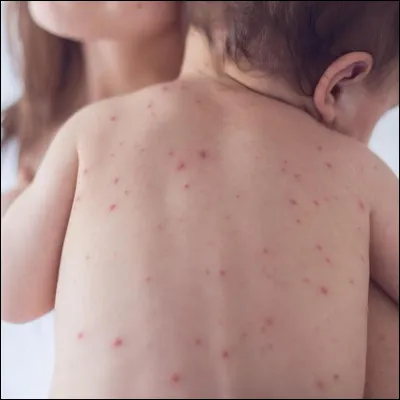 Le micro-organisme responsable de la varicelle est une bactérie.