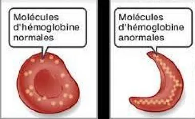 Santé : Quelle maladie génétique due à une anomalie de l'hémoglobine est aussi appelée anémie falciforme ?