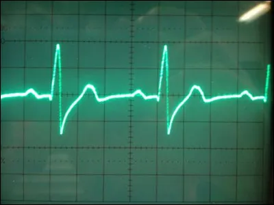 Pour un adulte, quel est le rythme cardiaque moyen au repos ?