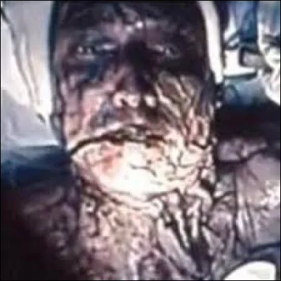 Comment s'appelle le virus ?