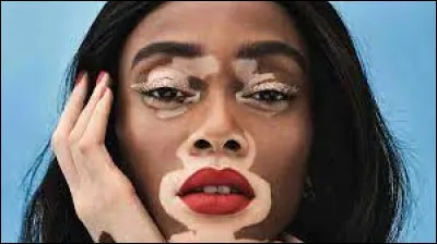 Quelle maladie se caractérise par des taches blanches (dépigmentation) sur la peau ?