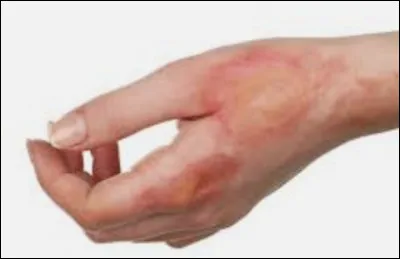 Si je me suis brûlé, que dois-je faire ?