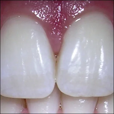 Quelles dents sont des incisives ?