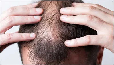 Quel terme désigne la perte des cheveux ou des poils ?