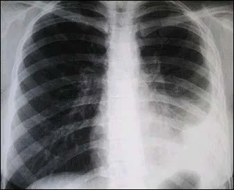 Quels rayons utilise-t-on pour prendre une radiographie pulmonaire ?