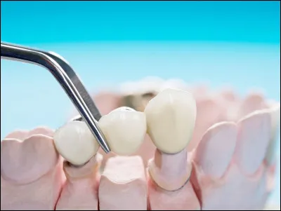 Le fluor protège les dents des caries.