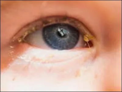 Comment s'appellent "les crottes des yeux" ?