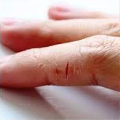 Quel type de traumatisme provoque des crevasses dans la peau ?