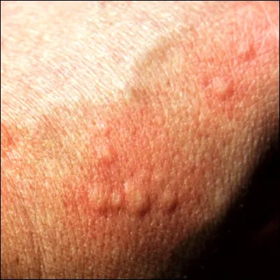 Quel insecte est jug&eacute; ind&eacute;sirable en raison de ses poils urticants ?