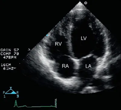 Un exemple de coupe d'échographie cardiaque. Saurez-vous me donner son nom ? (Faites-vous confiance, c'est faisable ;))