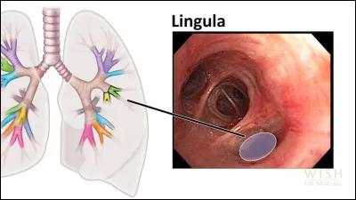 Quelle technique d'imagerie permet de visualiser l'arbre bronchique grâce à une petite caméra ? Elle peut être utilisée pour faire une biopsie du poumon, ou encore pour réaliser des analyses bactériologiques (recherche de bacille de Koch responsable de la tuberculose par exemple).