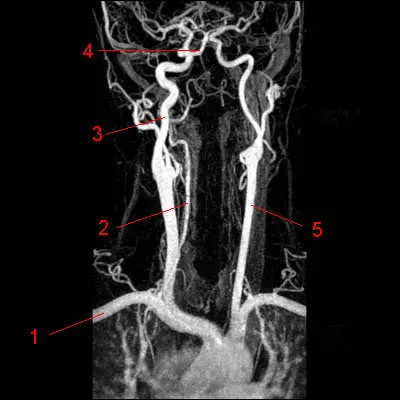 Le scanner peut aussi servir à visualiser les gros vaisseaux du corps humain tels que l'aorte ou les artères carotides. Pour cela, on va utiliser des produits de contraste iodés, qui vont venir opacifier les vaisseaux et ainsi sensibiliser la détection de lésions vasculaires. À quoi correspond le petit 5 sur cet angioscanner ?