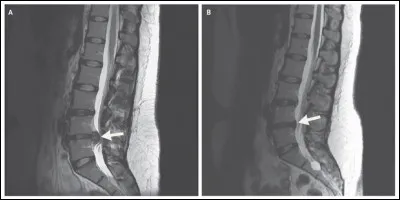 L'IRM est particulièrement utile dans l'étude du système nerveux central (cerveau et moelle épinière) en offrant une meilleure résolution que le scanner. Ci-contre, on peut observer une hernie discale qui, si elle est située au niveau des vertèbres L5-S1, peut se traduire cliniquement par...