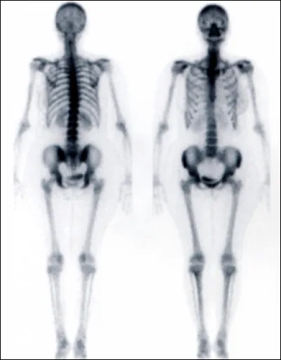 On termine ce quiz avec la scintigraphie. Pas de rayons X ou de champ magnétique, ici on utilise la radioactivité : on donne au patient un composé radioactif spécifique qui va par exemple se fixer sur le squelette. On va alors avoir un reflet du métabolisme osseux qui sera augmenté entre autres en cas d'infection ou de processus tumoral. Dans quel service utilise-t-on cette technique ?