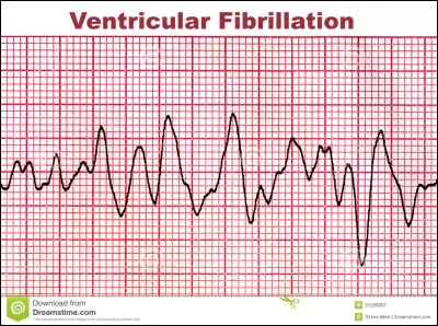 Une syncope peut aussi &ecirc;tre le sympt&ocirc;me d'un probl&egrave;me cardiaque. Quel trouble du rythme peut &ecirc;tre &agrave; l'origine d'une syncope ?