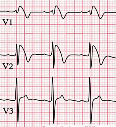 Chez un sujet jeune, la survenue d'une syncope, surtout au cours d'un effort physique, doit faire &eacute;voquer certains diagnostics, dont celui sugg&eacute;r&eacute; par l'&eacute;lectrocardiogramme ci-joint !