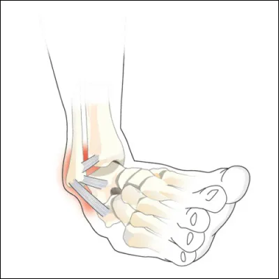 Sur l'image, est-ce une entorse ou une luxation ?