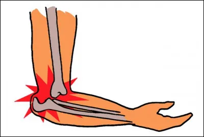 Sur l'image, est-ce une entorse ou une luxation ?