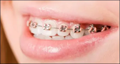 As-tu un appareil dentaire ?