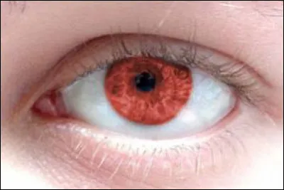 Comment appelle-t-on une personne avec les yeux rouges ?