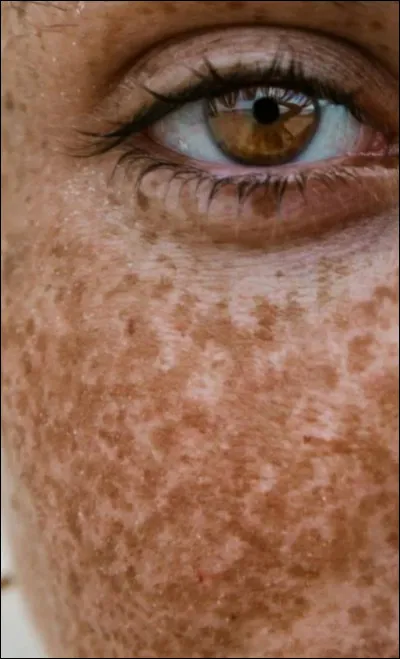 Comment on dit ''taches de rousseur" en anglais ?