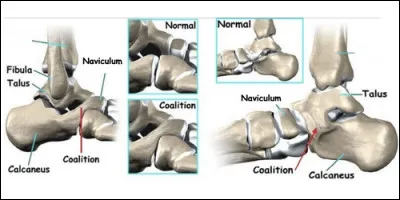 Dans quelle partie du corps trouve-t-on les métatarses ?