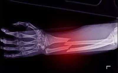 Que faut-il ajouter à "fra" pour obtenir ce qui désigne une rupture partielle ou complète d'un os ?