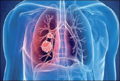 L'embolie gazeuse est une bulle d'air emprisonnée dans un vaisseau sanguin est la principale cause de décès dans quelle discipline ?