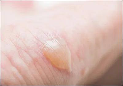 Quel est le genre du mot "phlyctène", lésion de la peau qui occasionne la création d'une bulle se remplissant de liquide séreux ?