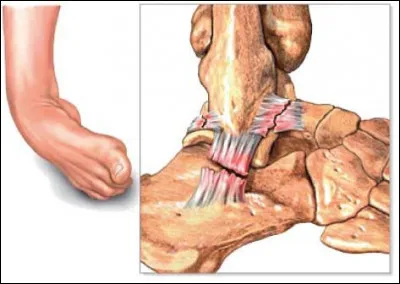 En cas de mouvement d'inversion en entorse, quel est le ligament qui est sûr de se lésionner ?