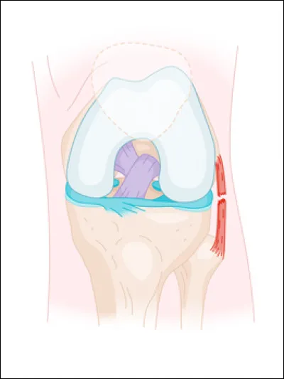 Quelle est l'information correcte concernant le ligament collatéral latéral du genou ?